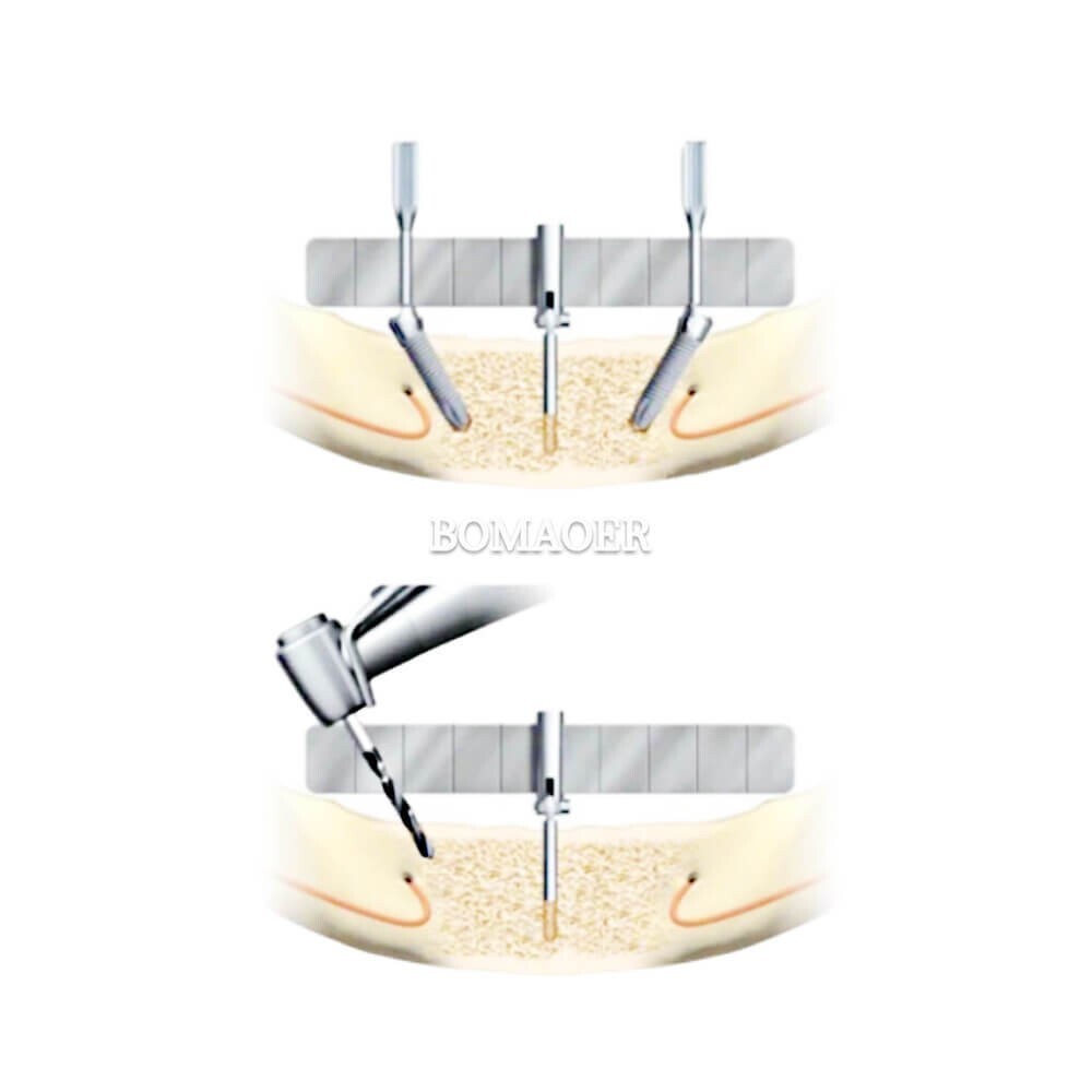 Dental Implant Locating Guide Planting Positioning Locator Surgical Ruler Gauge