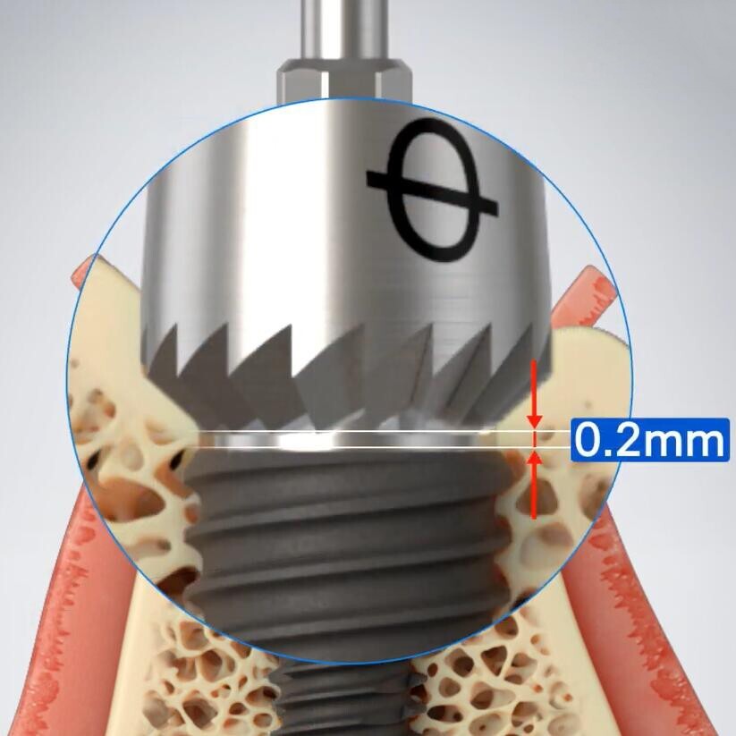 Hiossen Implant ET Bone Profiler Surgical Guide Screw Kit ABT 4.0 5.0 6.0 OSSTEM