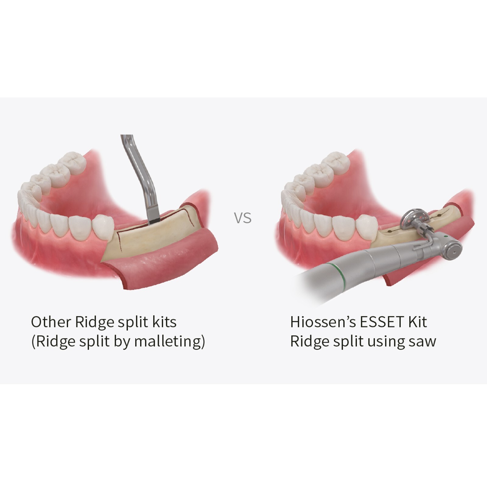 Implant ESSET Kit Easy Split Expansion of the Narrow Ridge Fits HIOSSEN OSSTEM