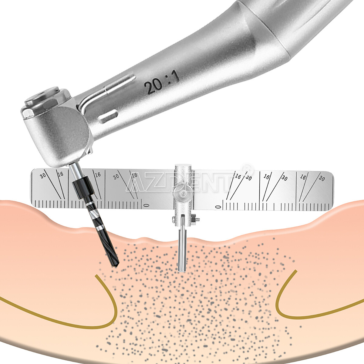 Dental Implant Locating Guide +2 Rulers Surgical Planting Positioning Locator