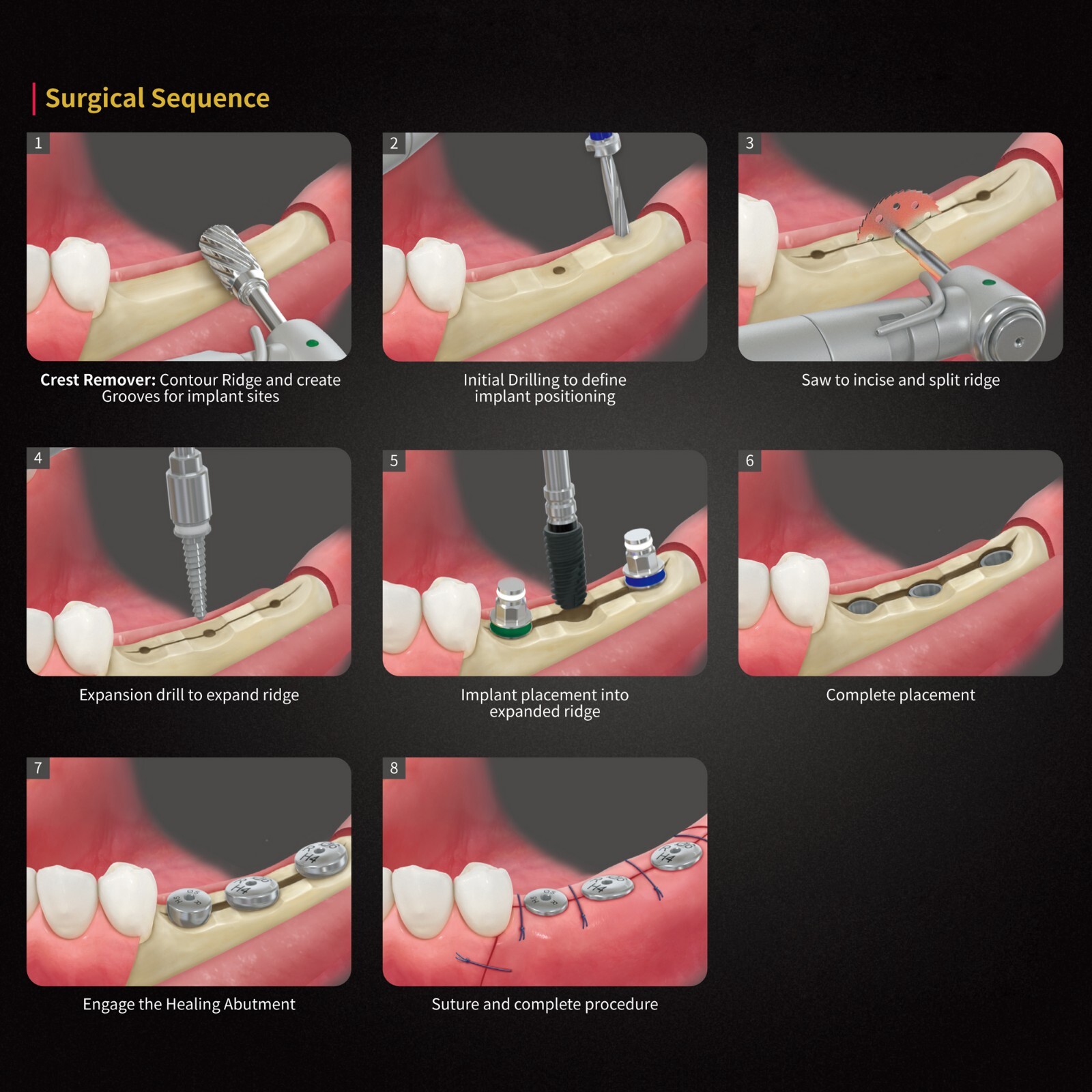 Implant ESSET Kit Easy Split Expansion of the Narrow Ridge Fits HIOSSEN OSSTEM