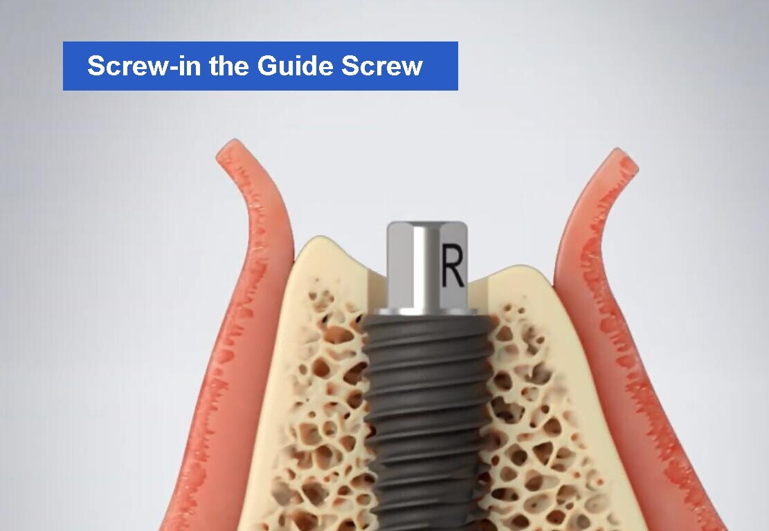 Hiossen Implant ET Bone Profiler Surgical Guide Screw Kit ABT 4.0 5.0 6.0 OSSTEM