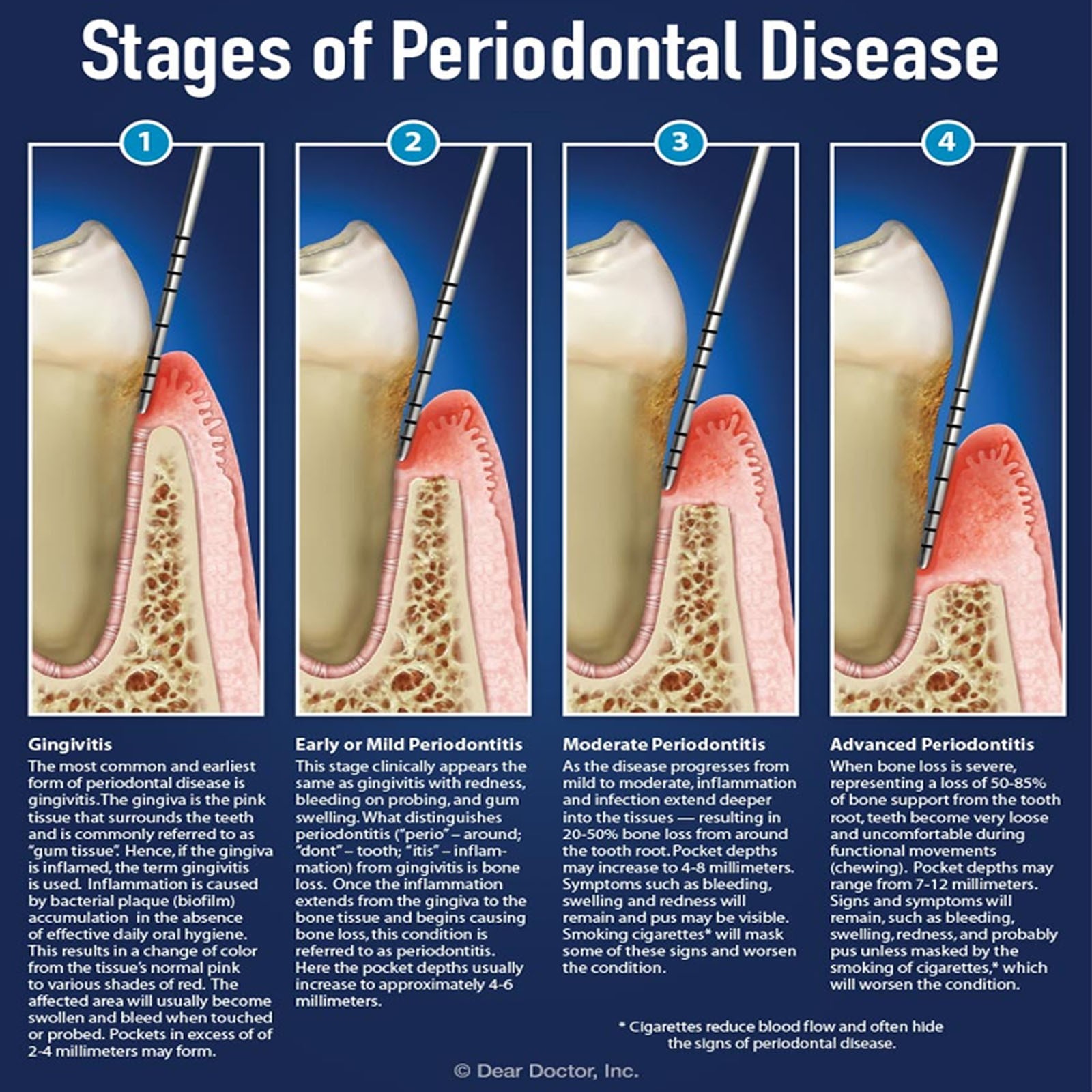 William Probes Color Coated Dental Periodontal Perio Probes