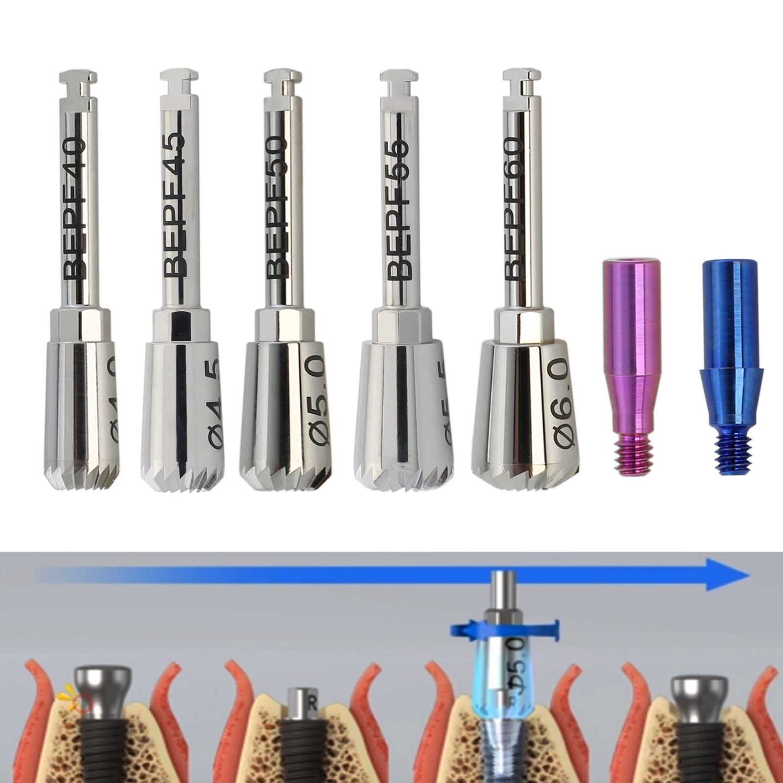 Implant Hiossen OSSTEM Bone Profiler & Guide Screws Kit Surgical Instrument