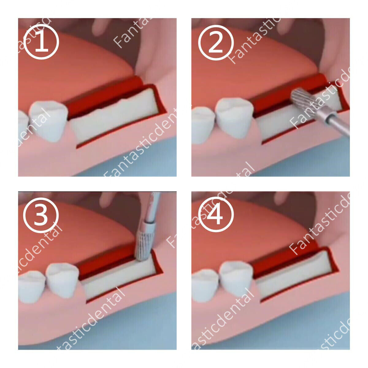 Dental Trimming Drill Crest Remover Shaping Sculpting Bone Ridge Contouring Bur