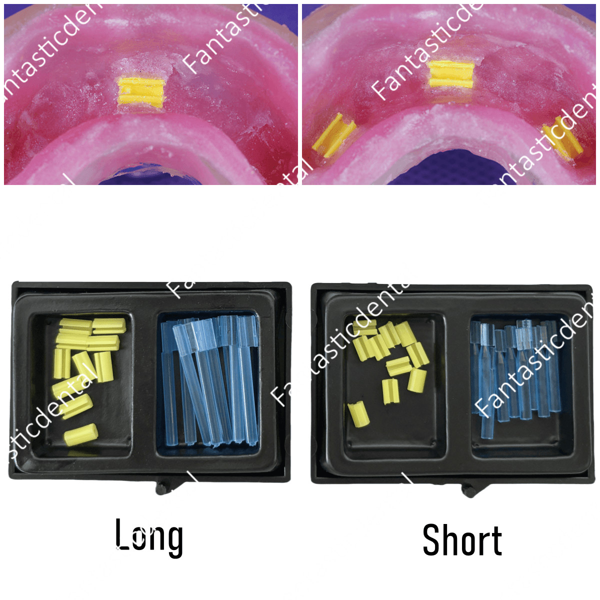 Dental Yellow Clips Overdenture Bar Attachment Retention Inserts Micro Hader