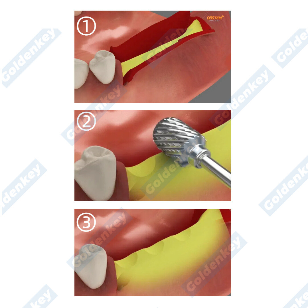 3Pcs Dental Trimming Drill Shaping Sculpting Bone Ridge Contouring Bur Ananas US