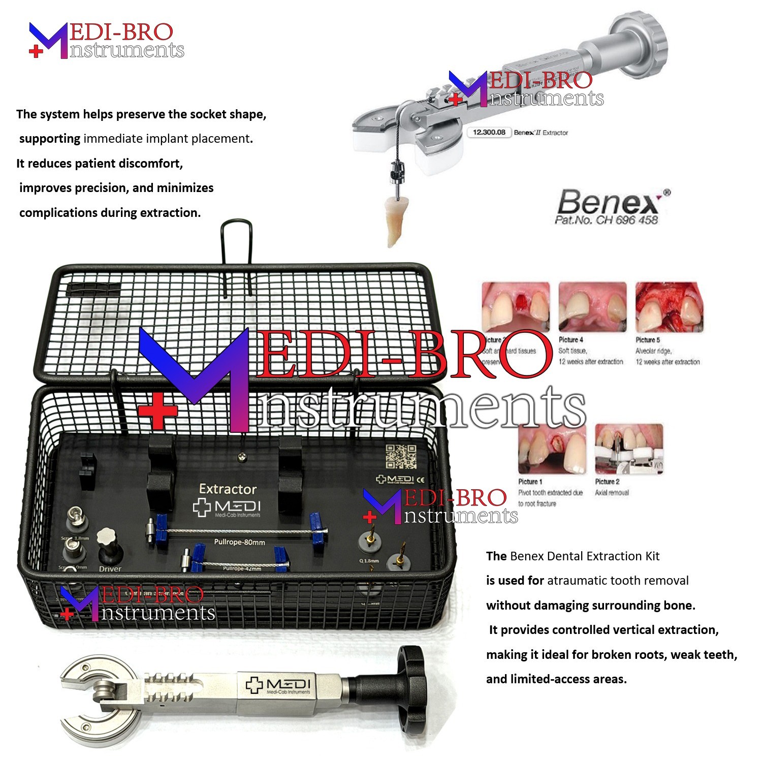BENEX Tooth Extraction System – Complete Dental Root Removal Kit Black