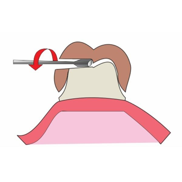 Crown & Bridge Removal Intruments, Crown Remover, Dental Orthodontic Instruments